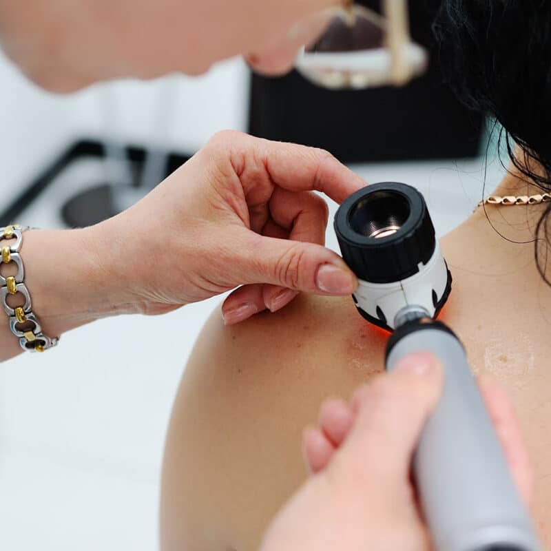 Doctor examining birthmarks and moles patient. examination of birthmarks and moles.the doctor examines the patient's mole