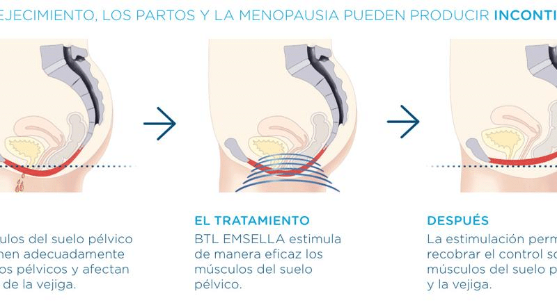 MUSCULOS_PELVICOS_TRAS_EMSELLA