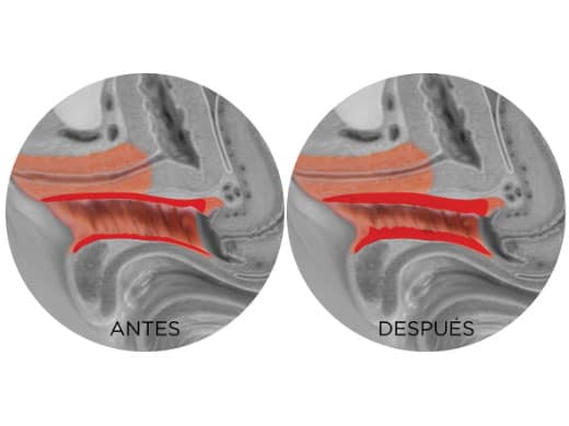 tratamiento-de-la-vagina-antes-y-despues-1